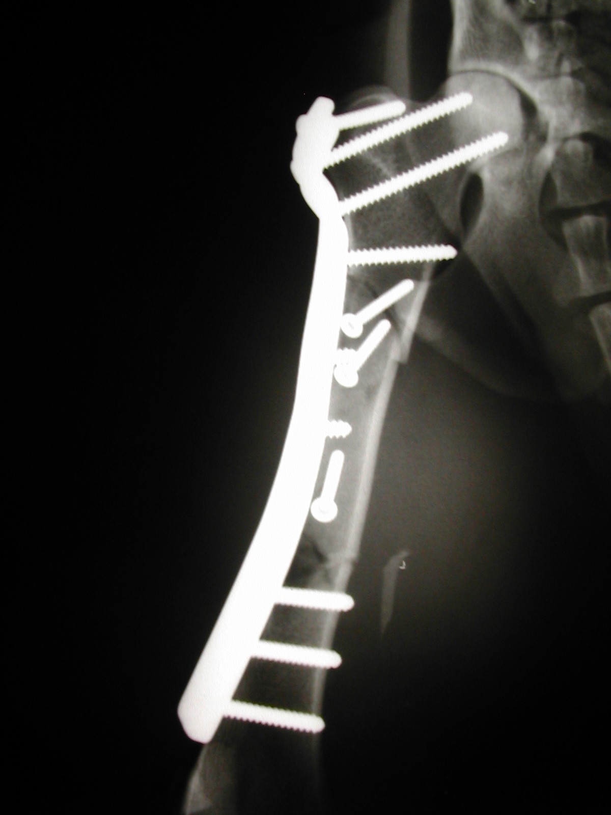 fracture femur